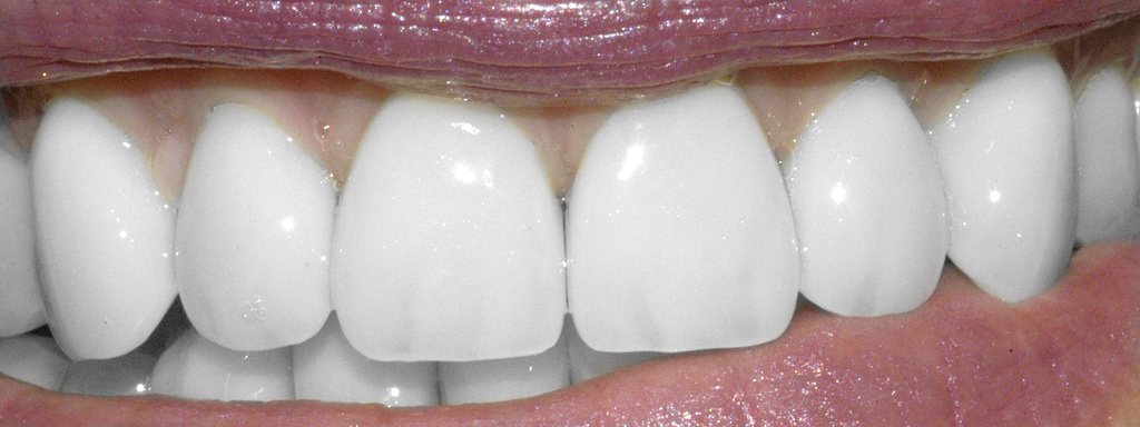 Tooth Metaphors